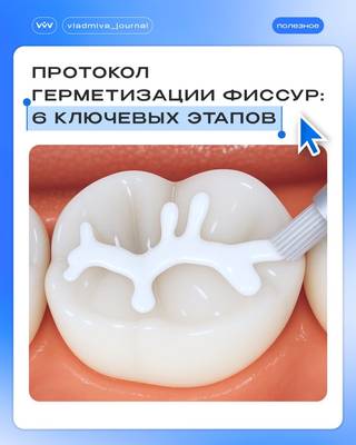 Шесть этапов герметизации фиссур: где скрывается ошибка?